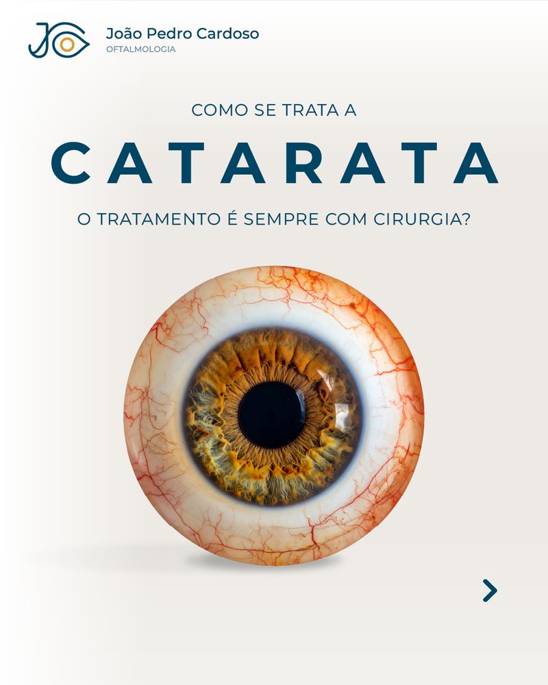 Publicação sobre o tratamento da catarata, a perguntar se é sempre com cirurgia