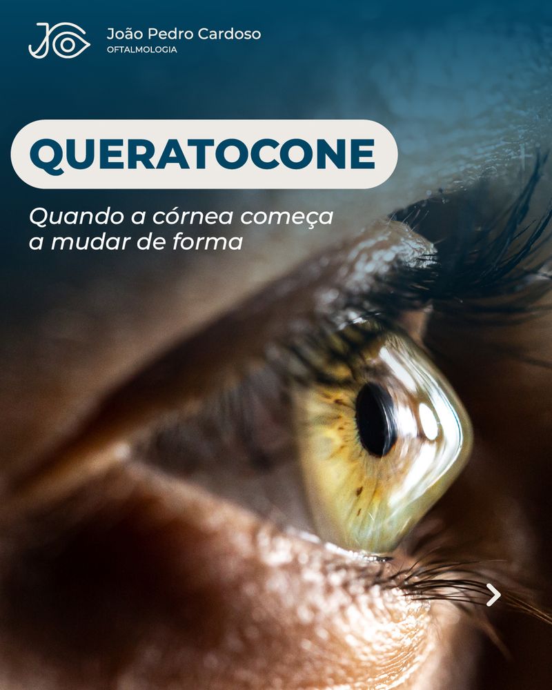 Publicação a explicar o queratocone, quando a córnea começa a mudar de forma, sobre macrofotografia de um olho